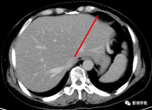 肝脏的表面解剖及分叶分段