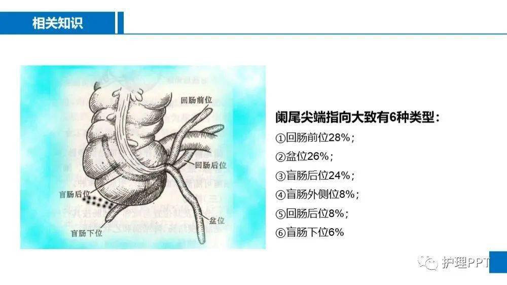 阑尾炎腰大肌试验图片