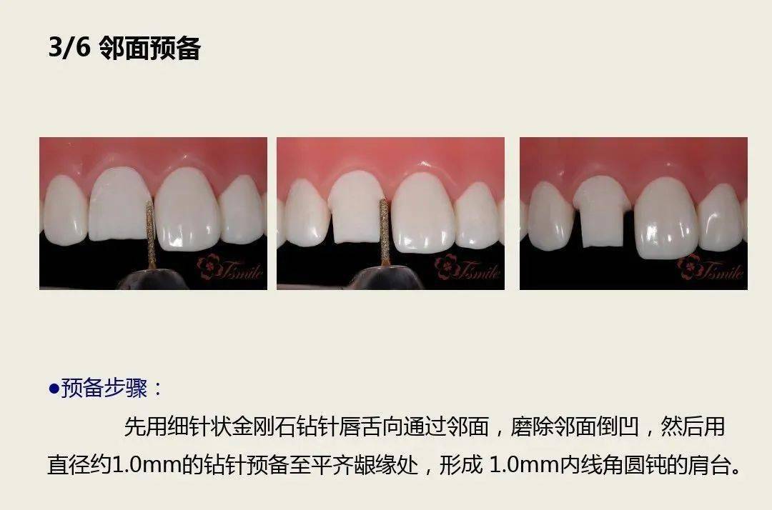 前牙全瓷冠的牙体预备_违规_侵权_版权