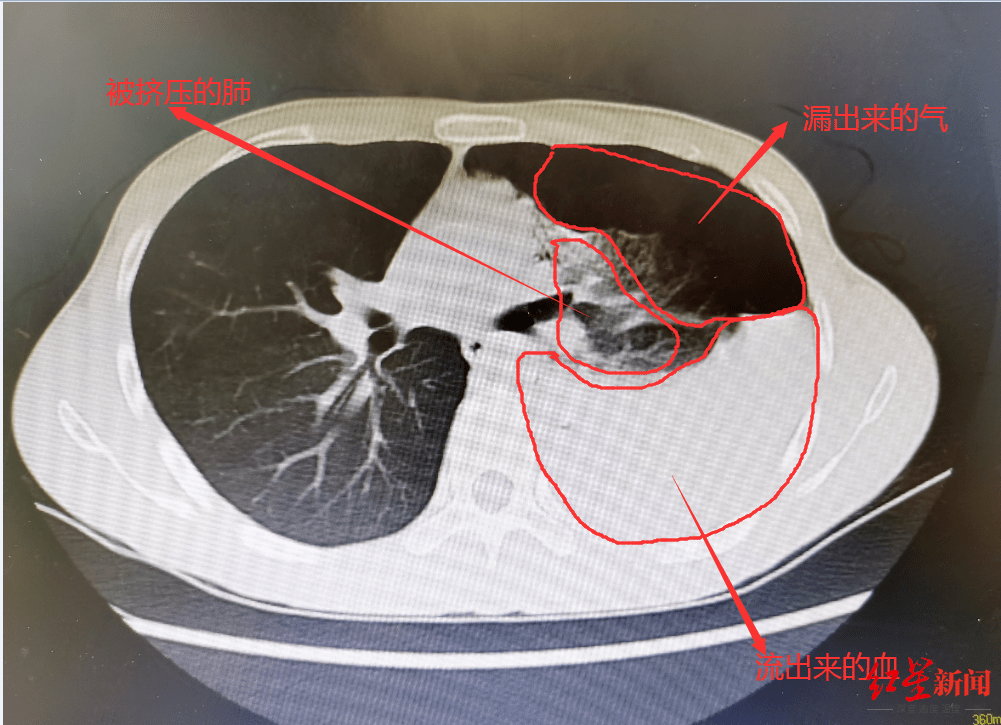 无24小时核酸 20岁小伙突发严重血气胸