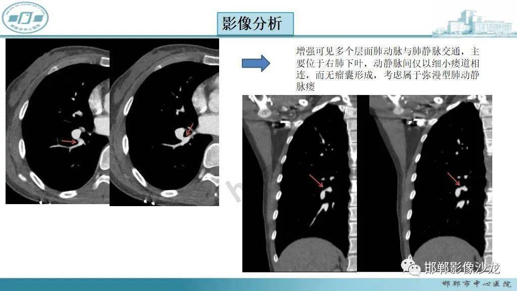 肺动静脉瘘与先天性心脏发育异常