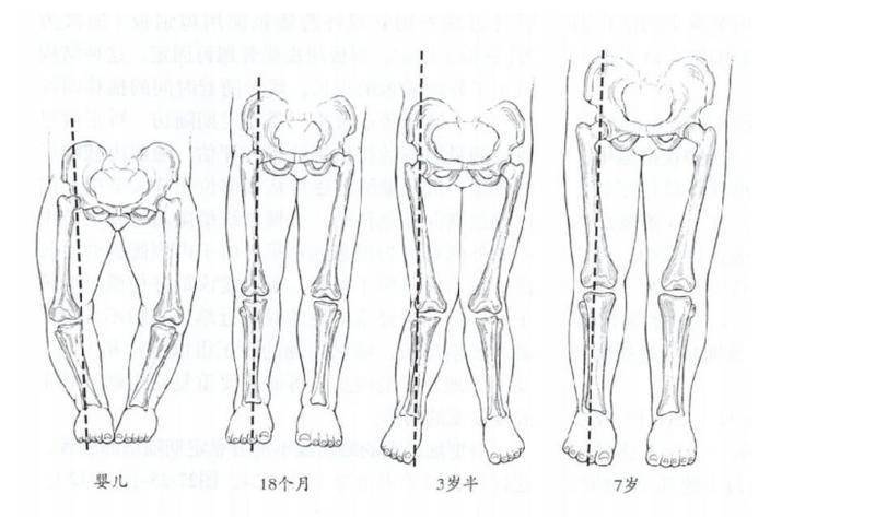 宝宝o形腿与x形腿是缺钙未必别用布缠腿了