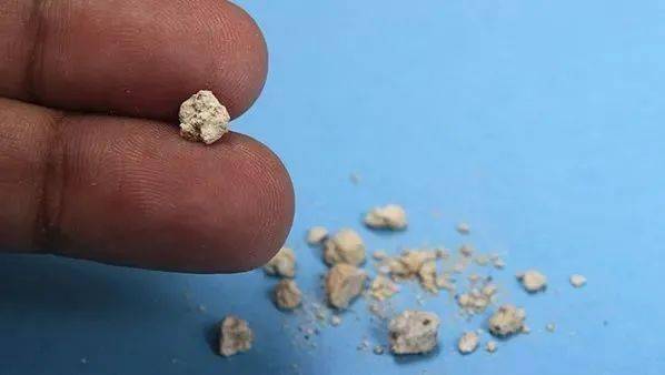 长期喝饮料,小心泌尿系统结石"盯"上你!专家讲解如何预防