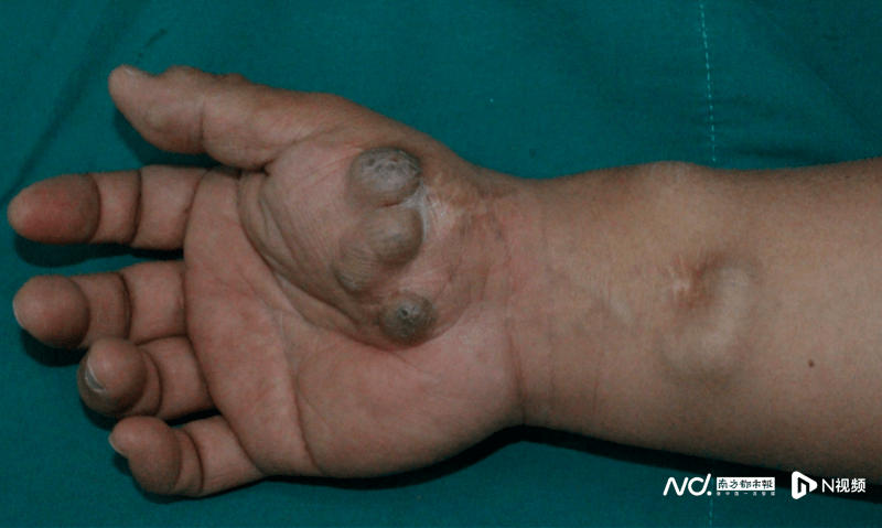 其余压之无痛,结合影像检查,诊断为静脉血管瘤