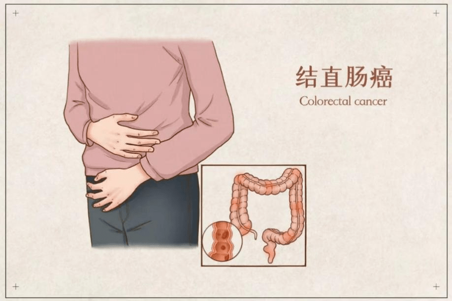 结直肠癌的危险因素、早期症状及预防_手机搜狐网