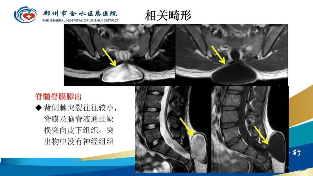 脊髓纵裂及相关疾病影像表现
