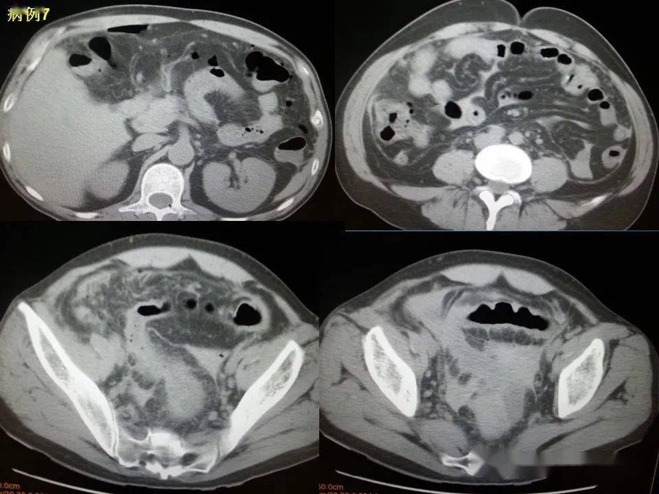 消化道穿孔ct影像大汇总看完印象深刻