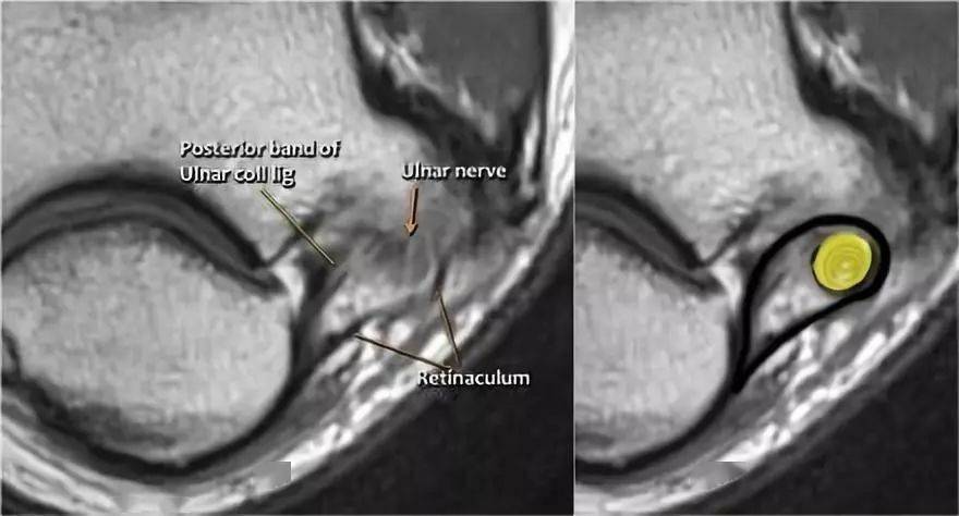 肘关节常见病的mri图谱详解