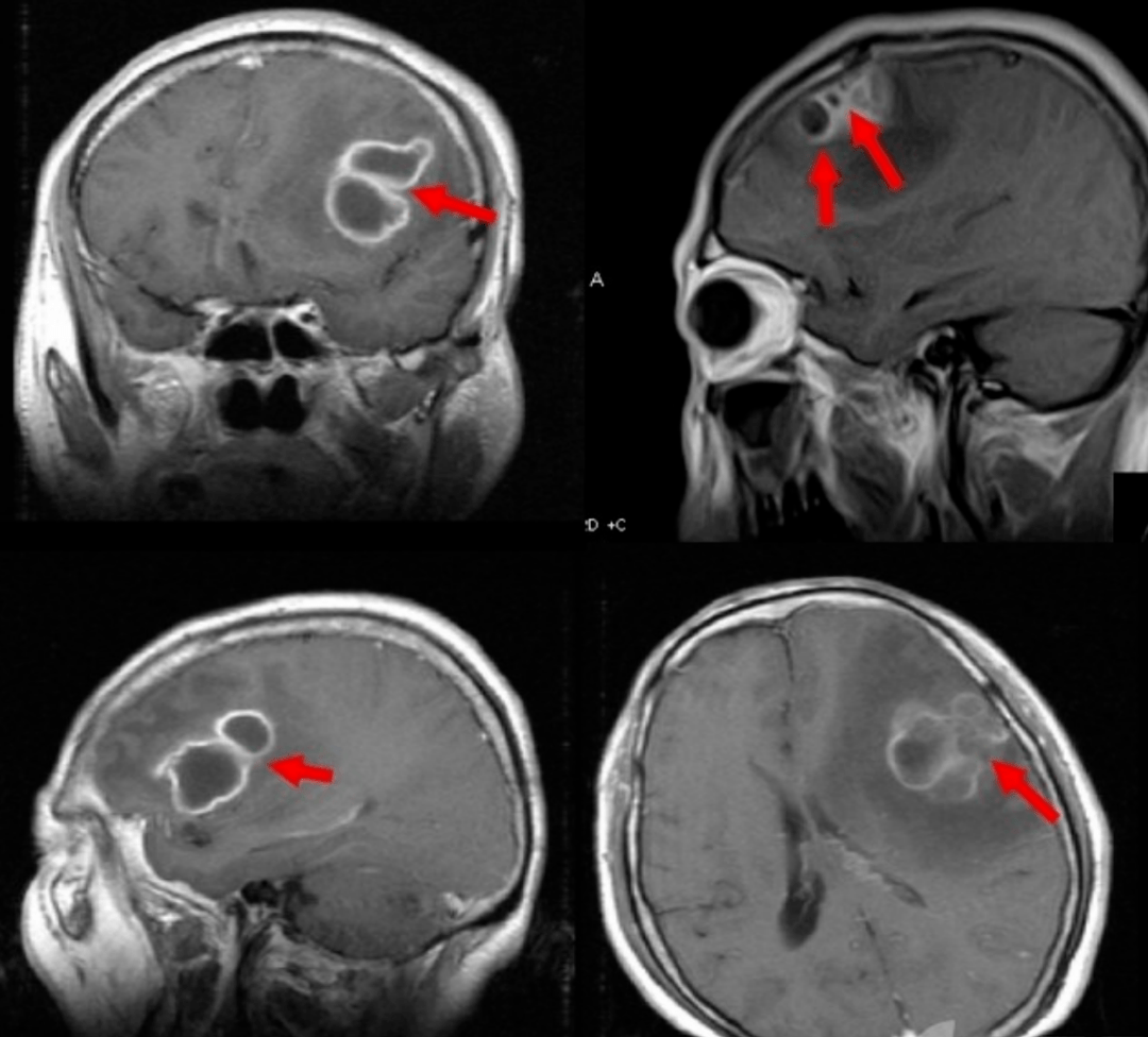 脑脓肿诊断图片