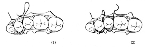 口内缝合术:_张力和_缝线_口腔
