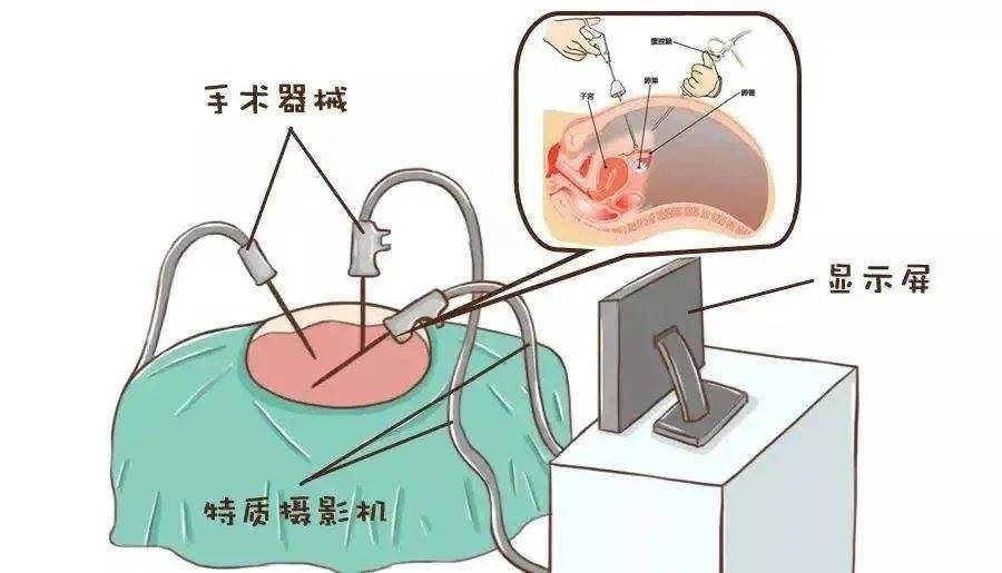 如孕6个多月诸城中医医院成功为一巨大子宫肌瘤患者实施腹腔镜手术