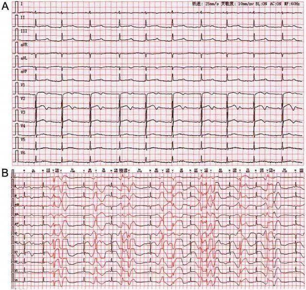 如何讀懂心電圖危急值