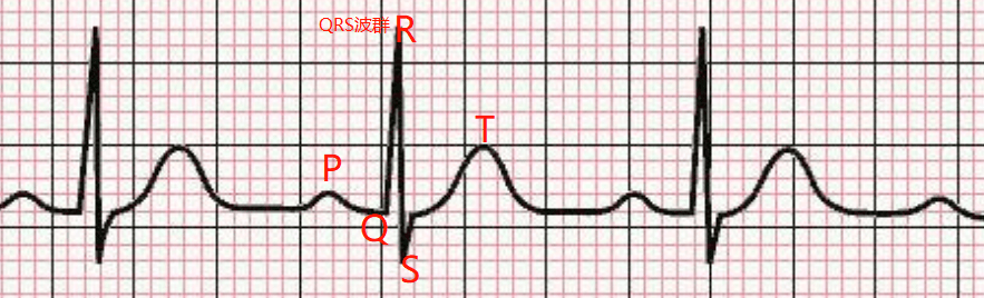正常心电图v2波形图示图片