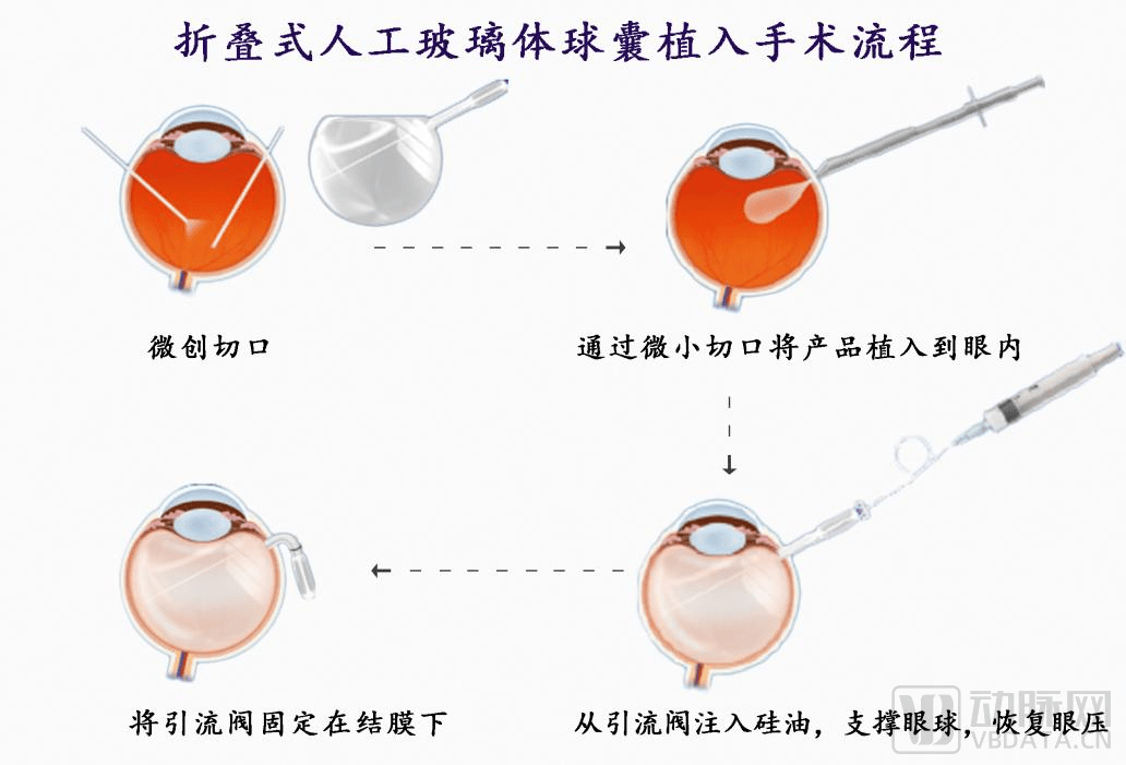 卫视博首创折叠式人工玻璃体球囊解决硅油依赖症等眼疾难题