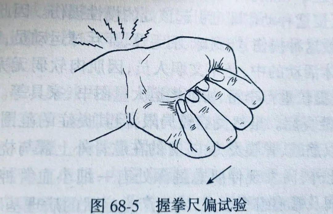 握拳尺偏试验阳性(做该动作时腕部出现疼痛).03排除手腕部外伤史.