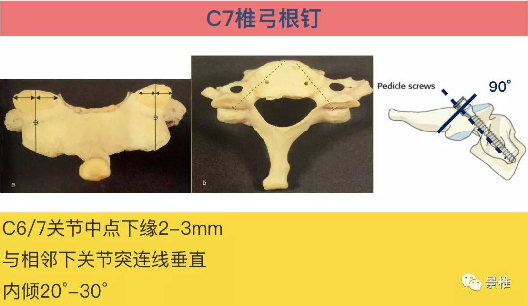 收藏丨胸椎颈椎腰椎椎弓根置钉技术