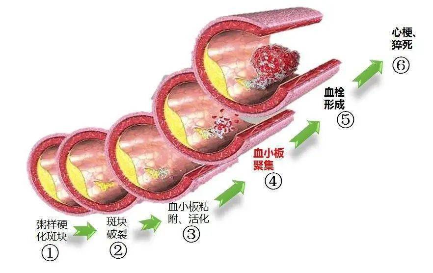 抗血小板药物影响手术麻醉吗?_医生_风险_血栓