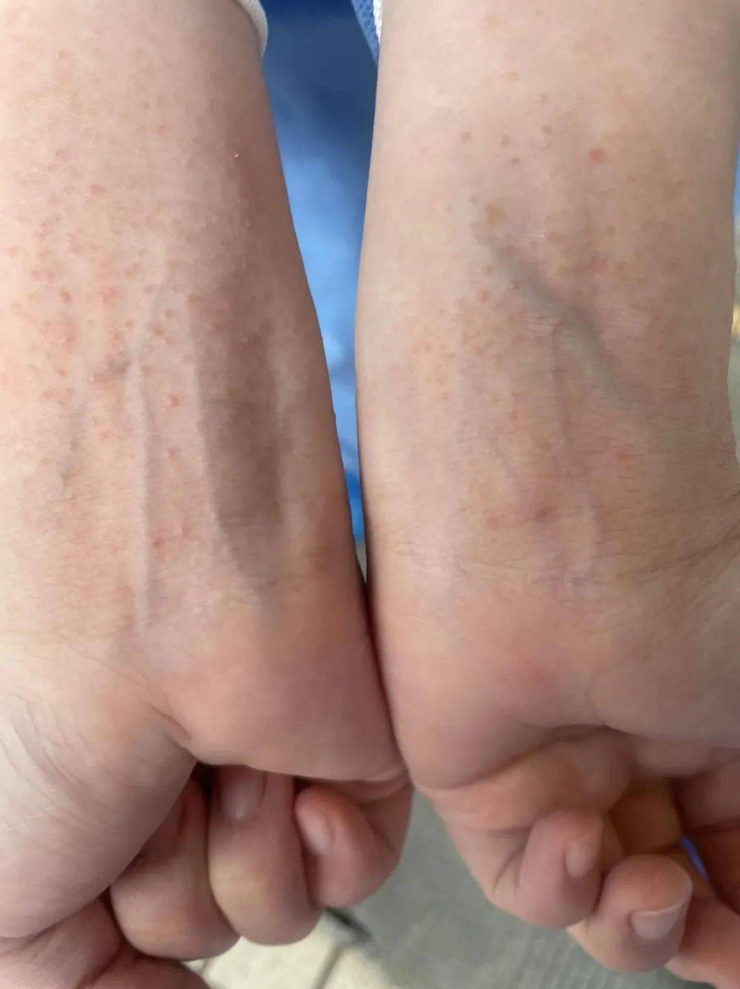 00起床,每天穿着防护服釆核酸有点累,皮肤因对酒精和橡胶手套过敏而