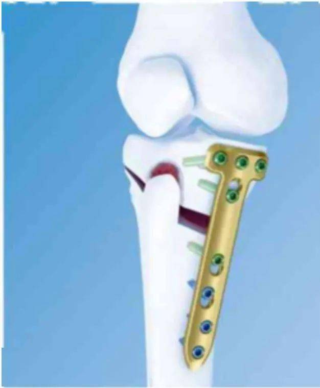 河西学院附属张掖人民医院成功开展张掖首例"胫骨高位截骨术(hto)"