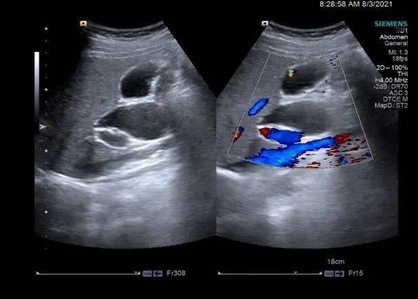 肝门处的这个囊肿,可不要忽视哦!_扩张_胆管_mmx