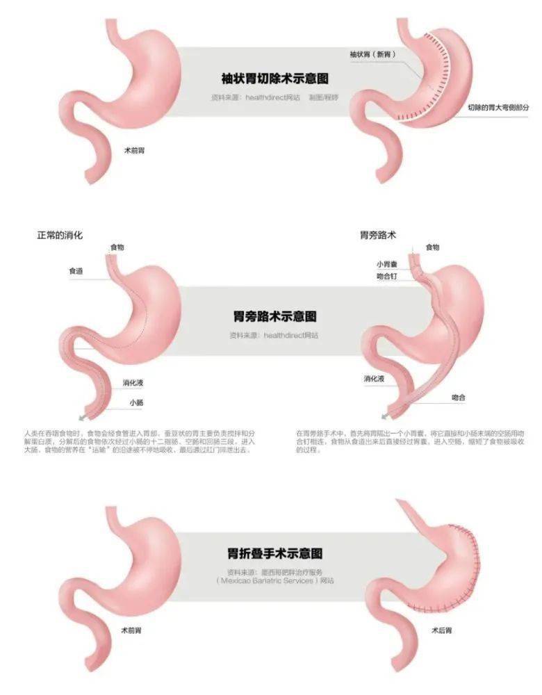 手术减肥_减肥手术哪种效果好_减肥手术是怎么做的