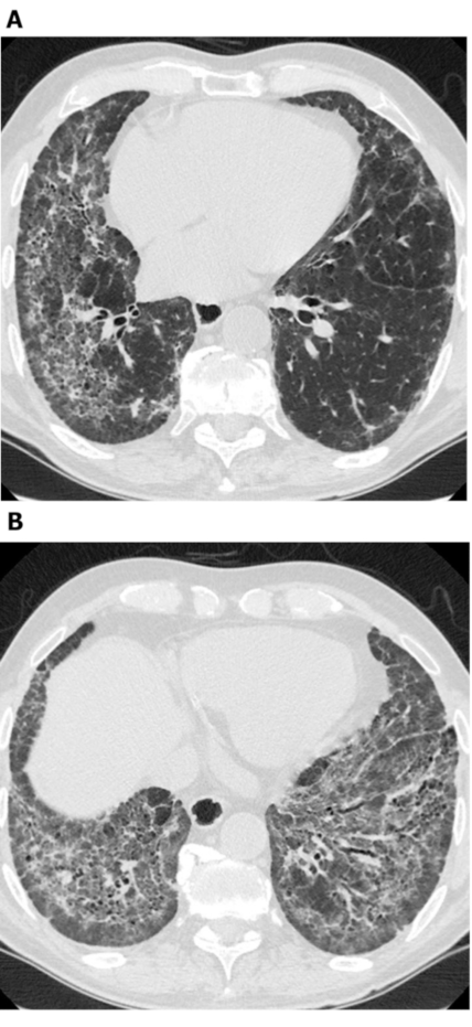 间质性肺炎影像学图片图片