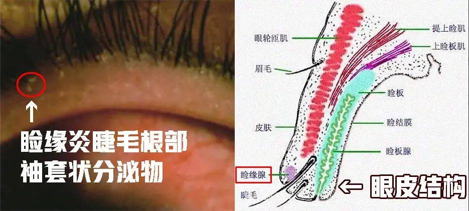 用眼过度的你,小心螨虫在睫毛安家