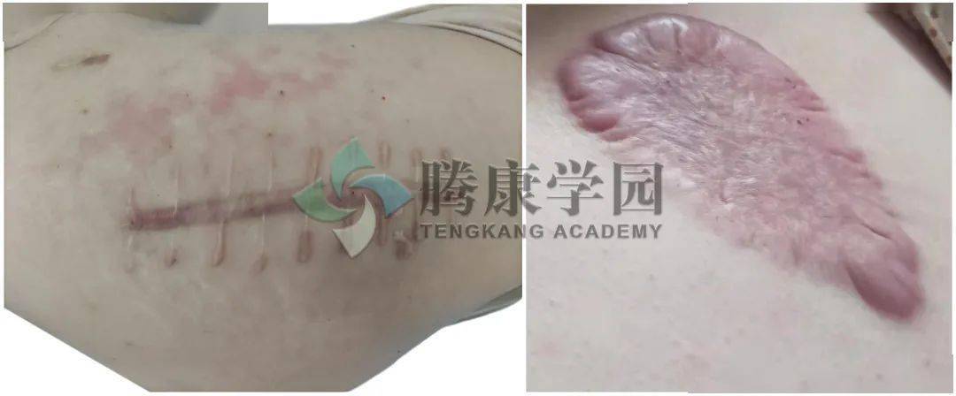 从筋膜看疼痛,什么是筋膜痛_结缔组织_疏松_皮肤