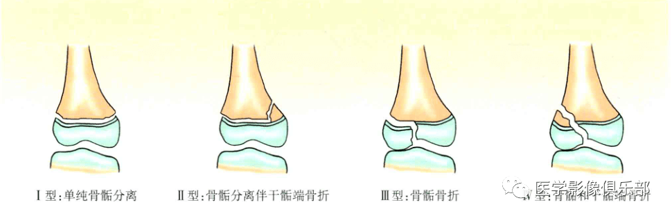 儿童骨骺损伤骨折分型