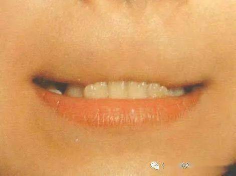 世界正畸健康日515科普发现乳牙地包天如何是好