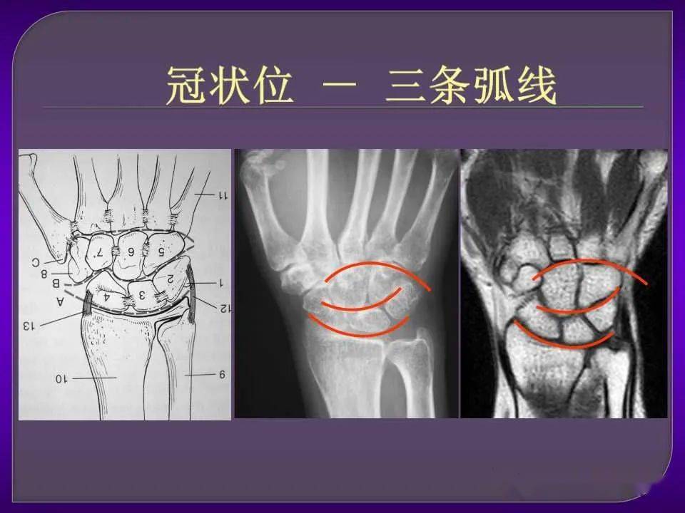 详细篇腕关节解剖及常见病变mri表现