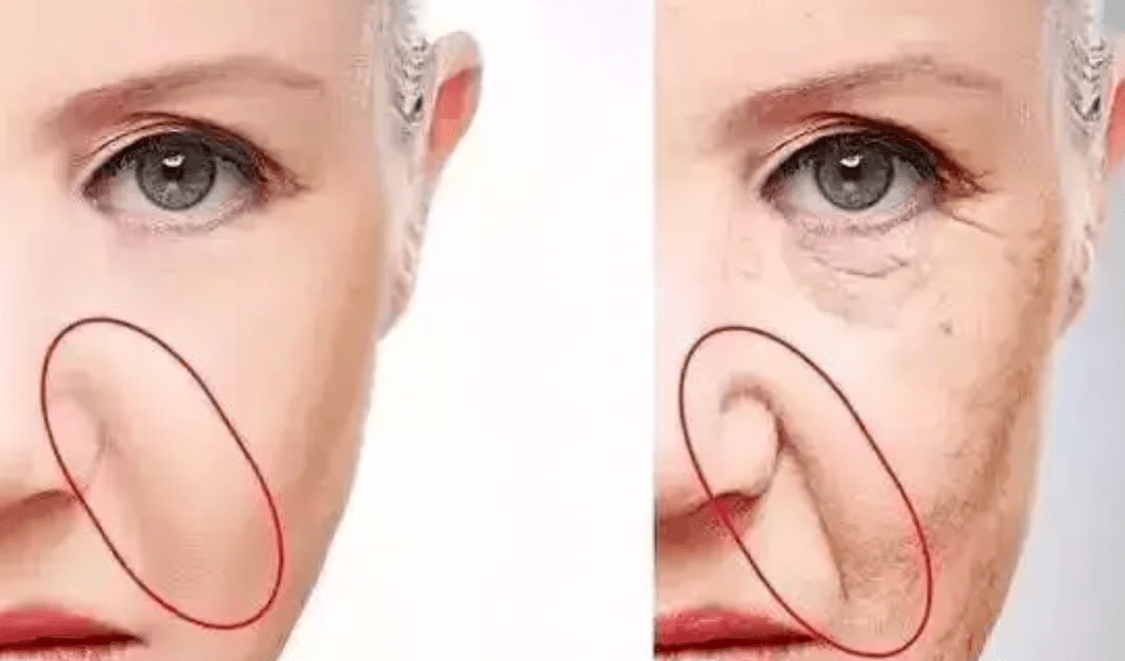 苹果肌法令纹凹陷有什么好用法子搞一搞