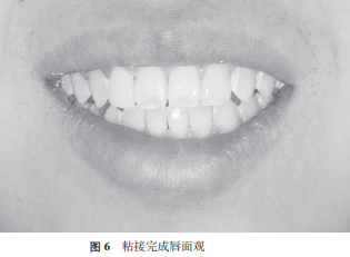 超薄瓷贴面修复双侧过小侧切牙1例