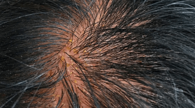 积医科普头皮有红斑掉屑不一定是脂溢性皮炎还有可能是这3种头皮疾病