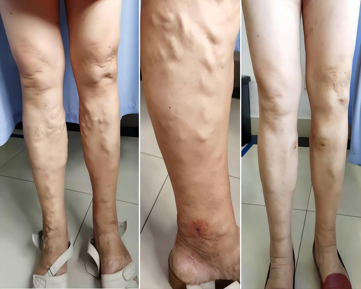 518全国血管健康日警惕低致死率的外周静脉疾病