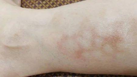 艾灸后皮肤出现淡浅红斑是我身体有问题吗