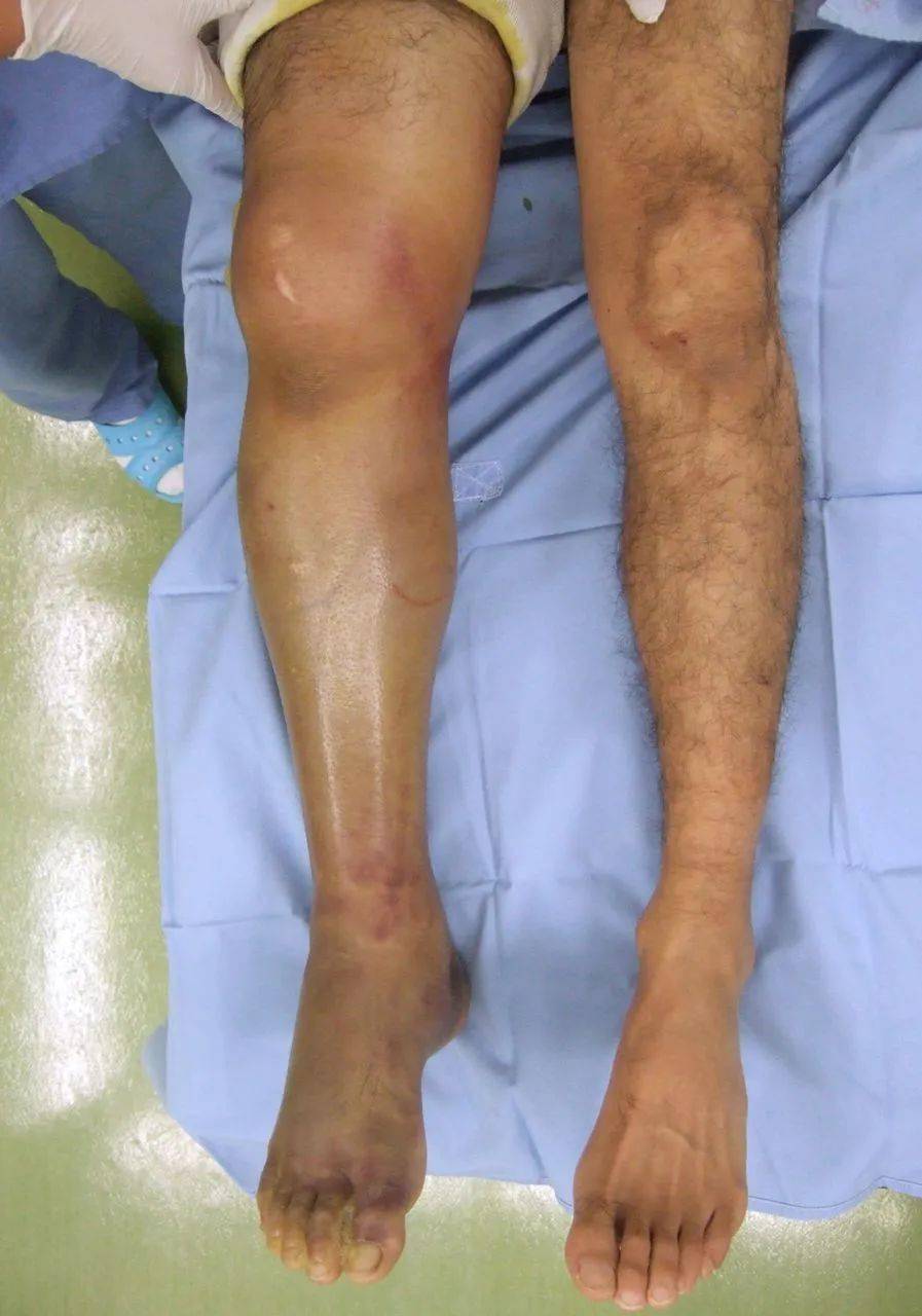 小腿骨筋膜室综合症图片