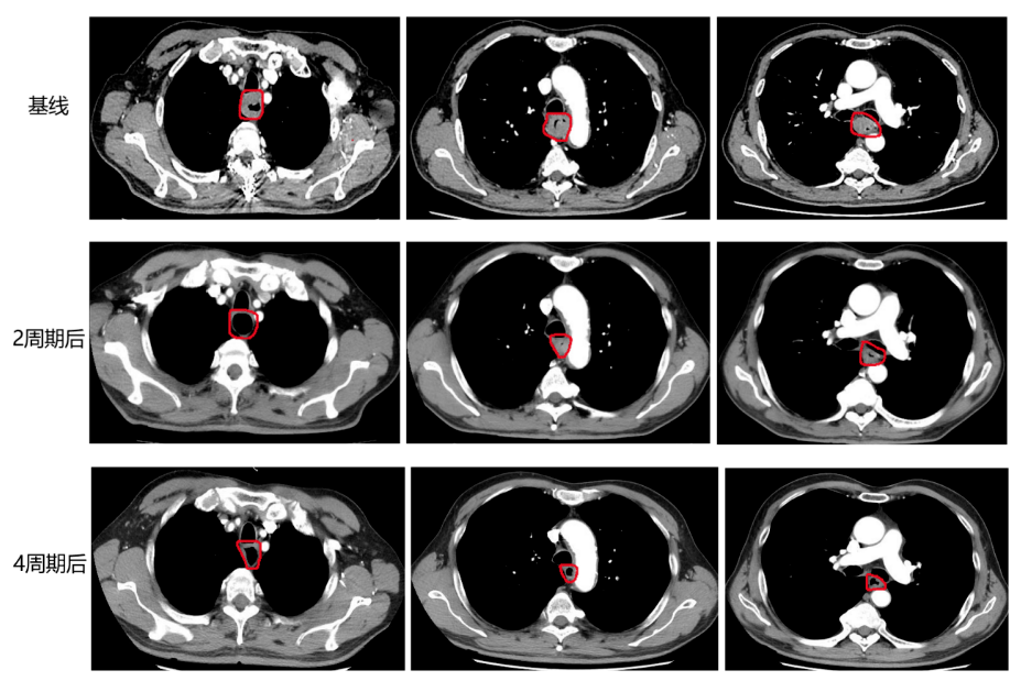 艾赋新生】高效低毒,卡瑞利珠单抗围手术期治疗为食管癌患者带来
