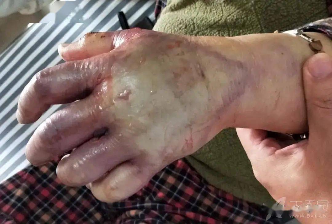 3 天前杀鱼时手部被鱼刺刺伤,昨日手部发肿,伴有疼痛,当地医院注射