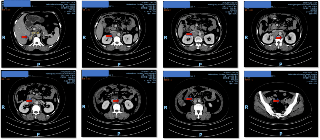 爱无止境优young好医声呋喹替尼为晚期结直肠癌后线治疗提供更多选择