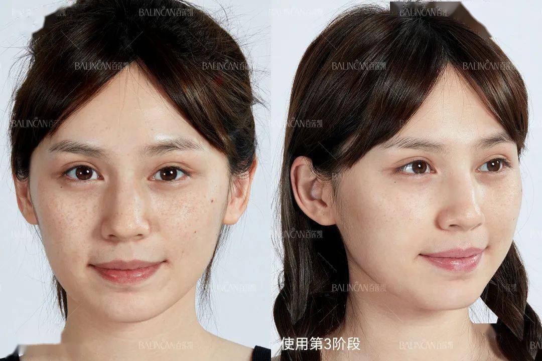 祛斑_患者_皮肤