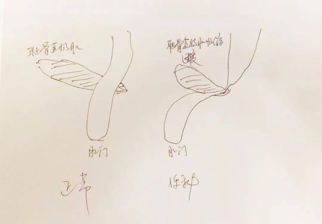 挤开塞露的正确姿势图片