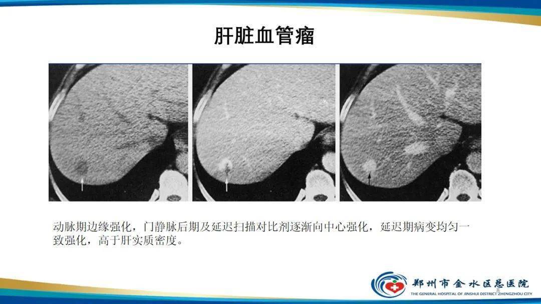 男性肝血管瘤图片