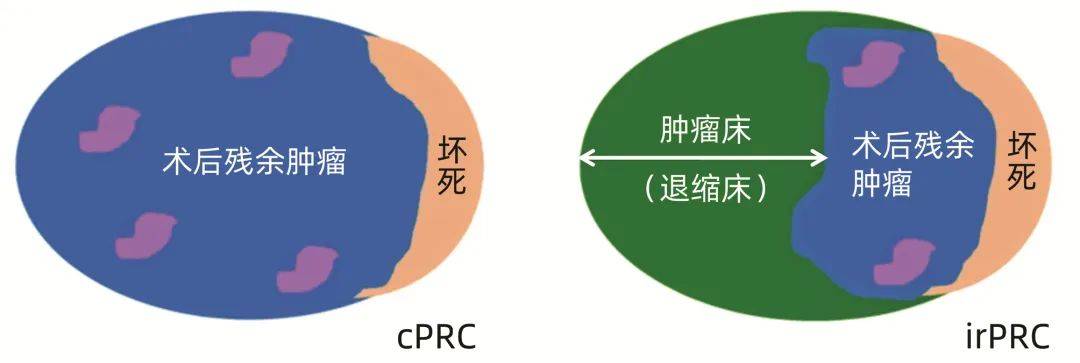 專家論壇楊朝旭中晚期肝細胞癌靶向聯合免疫治療進展