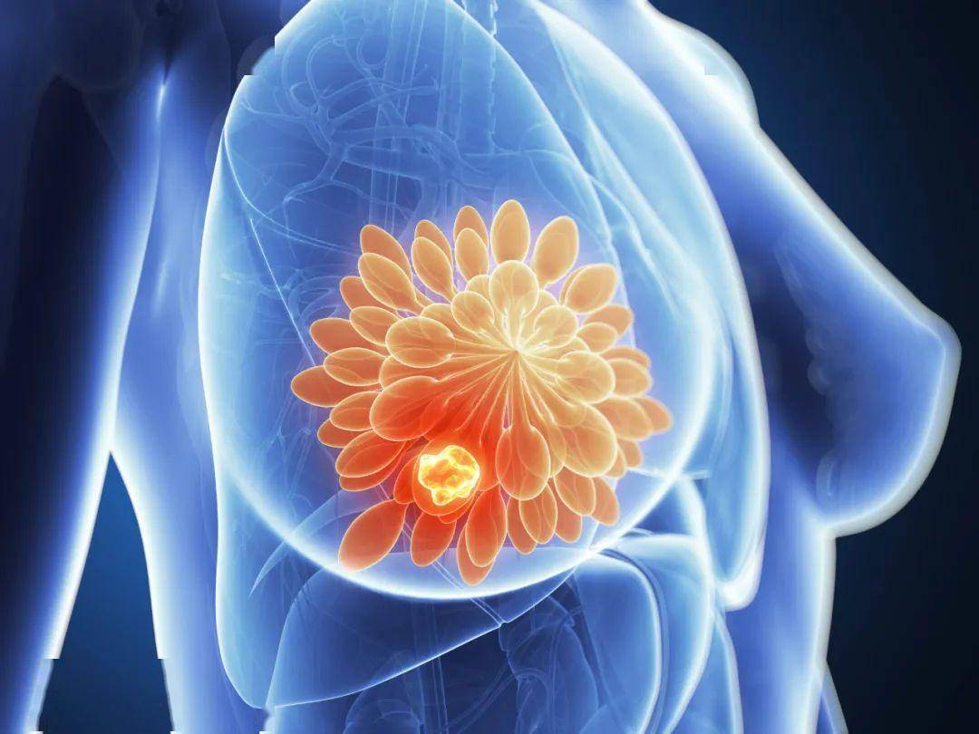 乳腺肿块 癌症图片