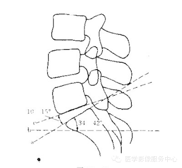 图解骶椎腰化腰椎骶化腰椎滑脱