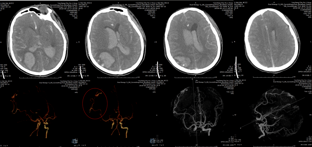 神外例说南医大一附院岳震手术后颅内感染的脑脊液综合管理曲鑫点评