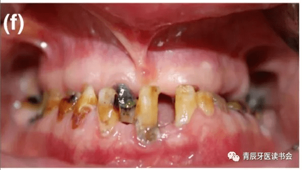 牛牙症的根管治疗