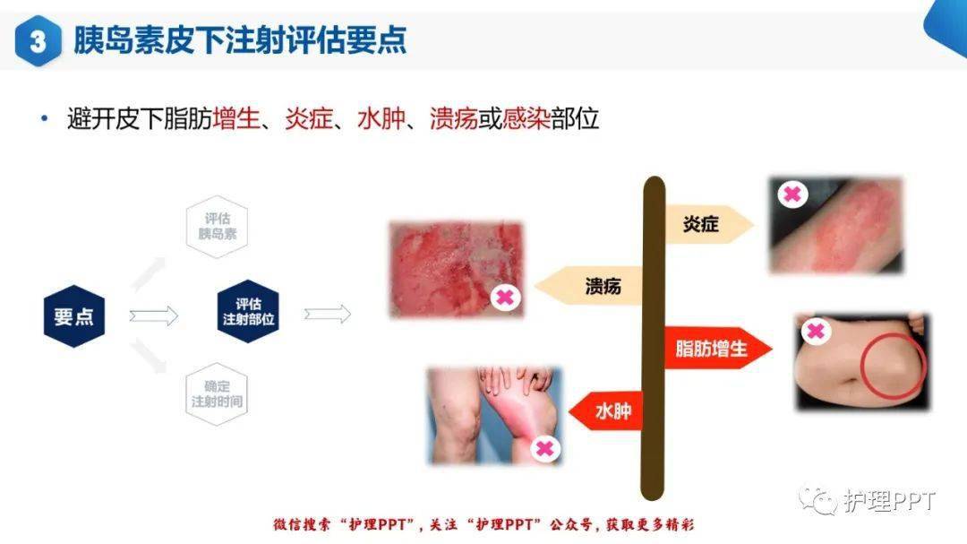 ppt胰島素皮下注射團體標準