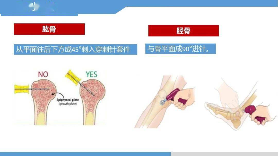 骨髓腔穿刺输液图解图片